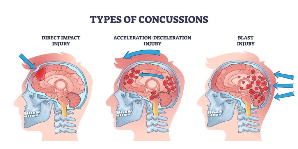 SANFORD A. KASSEL, APLC | Brain Injury Lawyers | San Bernardino, CA