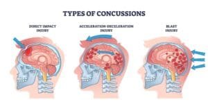 SANFORD A. KASSEL, APLC | Brain Injury Lawyers | San Bernardino, CA