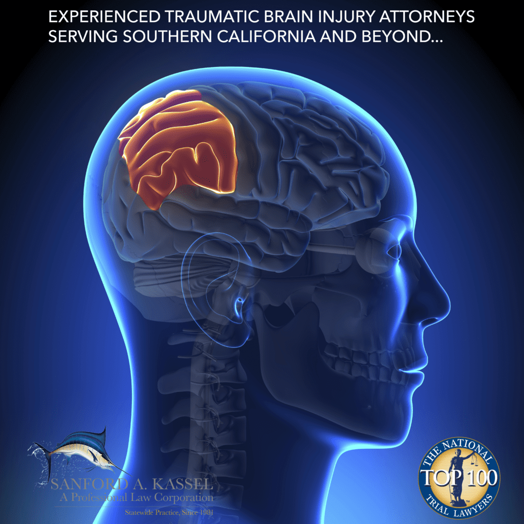 SANFORD A. KASSEL, APLC | Traumatic Brain Injury (TBI) Lawyers | San Bernardino California